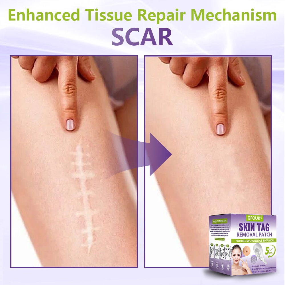 GFOUK® Soluble Microneedle Botanical Skin Tag Removal Patch